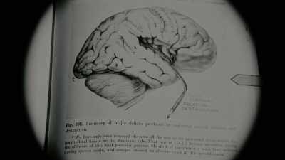 A patient referred to as "D.T." became speechless - The Minds of Men