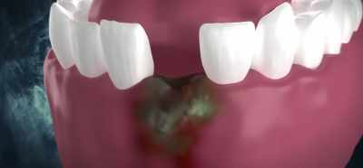 Afterwards, we have to drain
the area from the bacteria - Root Cause