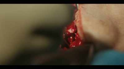 All right, it's out.
There's the bone fragment. - Painkiller