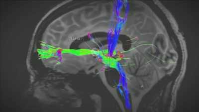 {\an1}By electrically stimulating, - Mysteries of Mental Illness