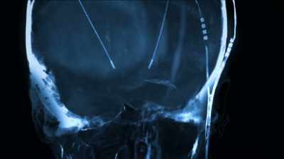 {\an1}NARRATOR: In deep brain
stimulation, or DBS, - Mysteries of Mental Illness