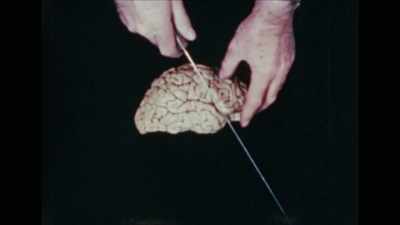 {\an1}Some wondered, could surgically
severing the frontal lobe - Mysteries of Mental Illness