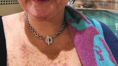 And I also have
gastroparesis, which - The Diabetes Solution