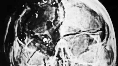 And one way to support it is to remove - JFK: What The Doctors Saw