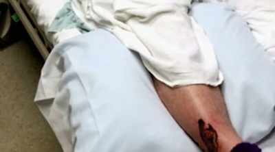 And is treated for puncture
wounds to his back and leg. - Shark Attack Files