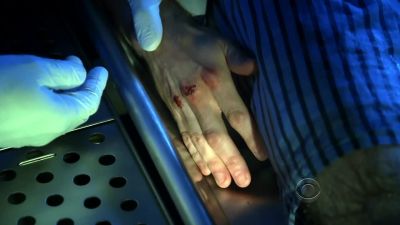 Ante-mortem abrasions on
the second and third knuckle. - CSI: Crime Scene Investigation