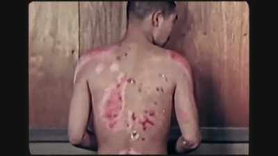 Any place that got
slightly bruised had
a hemorrhage underneath - Hiroshima and Nagasaki: 75 Years Later