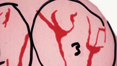 BACK RIGHT CORNER OF THE HEAD, - An American Murder Mystery: The Staircase