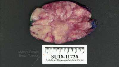 Benign tumour. - Toxic Beauty