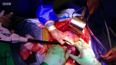 But this is not for people who are
chicken-hearted. - Surgeons: At the Edge of Life