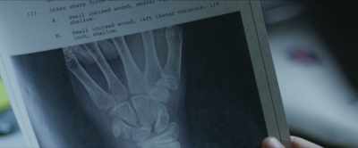 "Deceased presents with
breaks to the radius distal ulna - Devils