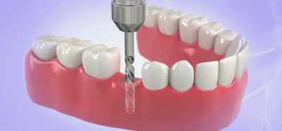 [Dr. Breiner]
An implant is where you're going - Root Cause