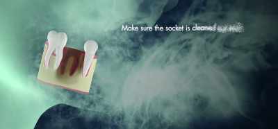[Dr. Breiner]
When that tooth comes out, - Root Cause