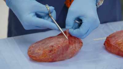- [Dr. Chun] Now you
always want to make sure - Explant