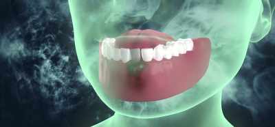 [Dr. Rau]
Removing the root canal tooth - Root Cause