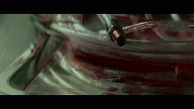 ECMO port capped. - Birth/Rebirth