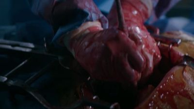 - Fever's spiking.
- Sepsis is worsening. - The Resident