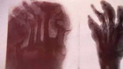 First it started
in my right toe, - The Invisible Pilot