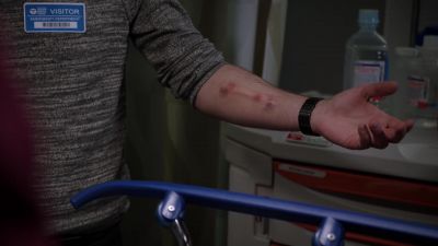 Fistula for dialysis - Chicago Med