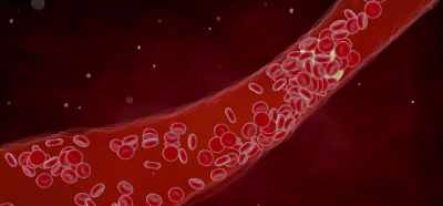 For instance, the person could
have a clotting disease - Root Cause