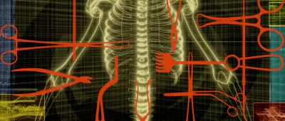 From my lumbar Sspinal-fusion surgery, - Pain and Glory