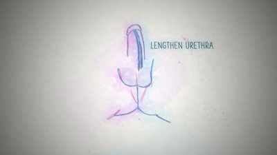Further surgeries may involve
lengthening the urethra, creating - Naked Education
