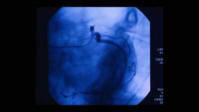 He'd just had a cardiac
catheter go wrong, - Surviving Death