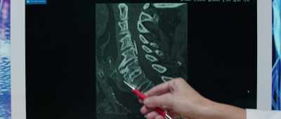 Here, you can see the esophagus displaced
by this ossification. - Pain and Glory