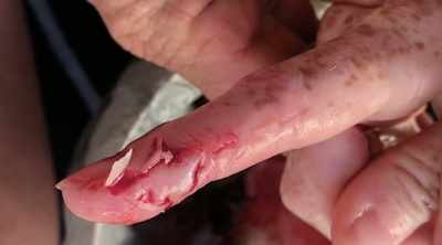 I couldn't even look at
the finger and I thought if - Shark Attack Files