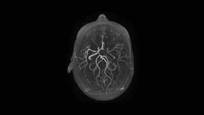 I was diagnosed in December of 2015, - Explained