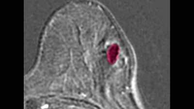 I had invasive
with HER2 amplification, - The Magic Pill