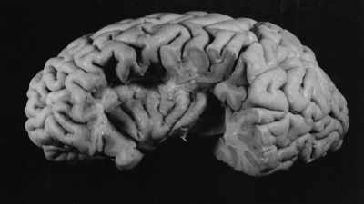 - I remember her describing it
at the time - The Man Who Stole Einstein's Brain