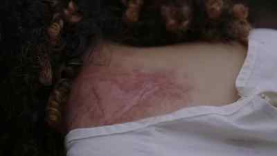 I think the Debris has
been implanted under her skin. - Debris
