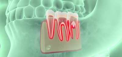 If a tooth is properly pulled,
when the tooth is out, - Root Cause