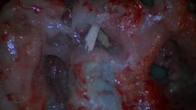 I'm finding fragments of petrous bone - The X-Files