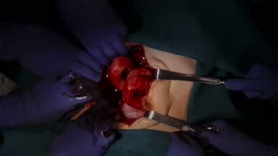 Internal bleeding. - The Good Doctor