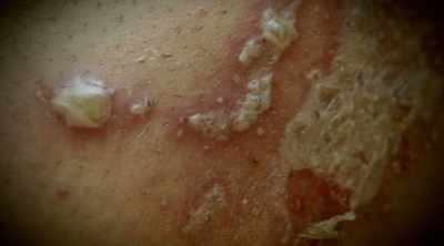 It just caused this nasty,
huge, open wound. - Kings of Pain