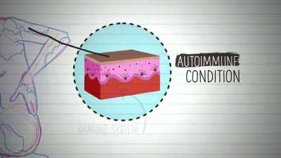 It is thought to be caused
by an autoimmune condition - Naked Education