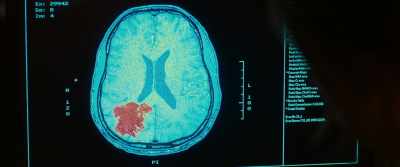 It's a glioblastoma multiforme,
that is covering - Death of a Ladies' Man
