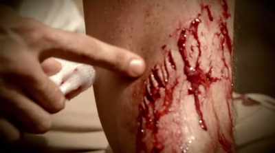 It's like knife wounds
all around my arm. - Kings of Pain