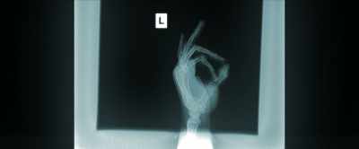 I've broken my right foot,
toes, and fingers - Kelce