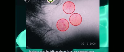 LESIONS CHARACTERISTIC
OF ASPHYXIA DUE TO STRANGULATION - A Life Too Short: The Isabella Nardoni Case