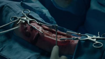 Let's start
the debridement. - The Resident