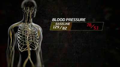 - Looks like a low blood
pressure, - Kings of Pain
