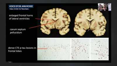 - MICHAEL: Dr. Ann McKee
is a neuropathologist - Impact x Nightline