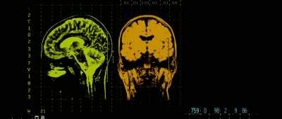 Migraines, tension or cluster headaches, - Pain and Glory