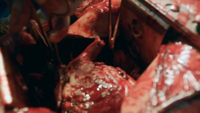 MINA:
Dividing the pulmonary veins - The Resident