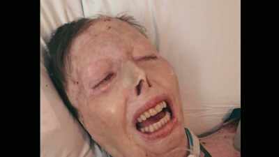  Most burn victims require - The Fire That Took Her