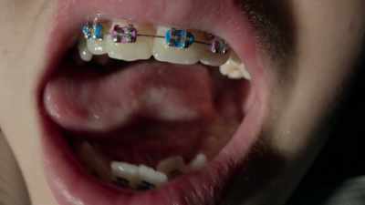 Most orthodontic treatment flattens faces. - Open Wide