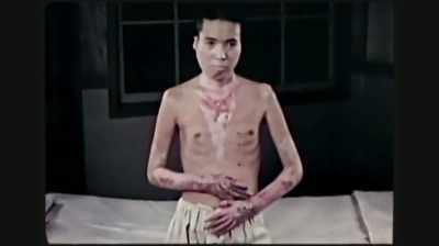 Mostly face, chest, and arms. - Hiroshima and Nagasaki: 75 Years Later